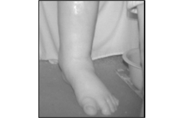 A swollen foot and lower leg detected by the scanner