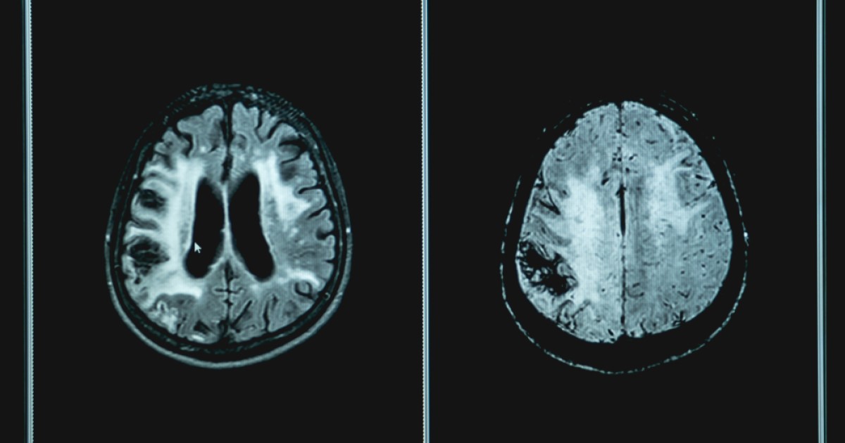An MRI scan of a brain shows damage