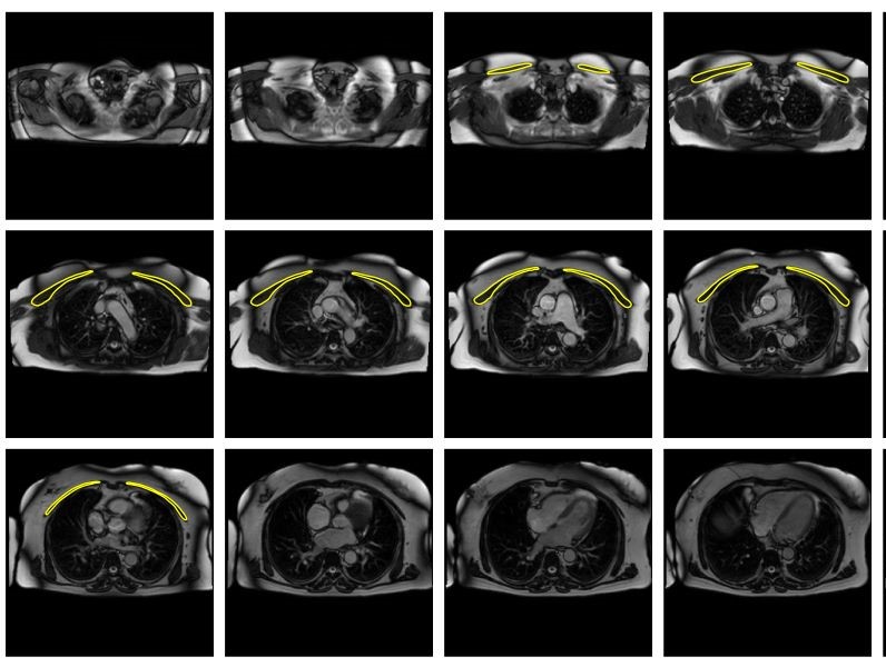 A series of chest scan images showing the pectoral muscle outlined in yellow