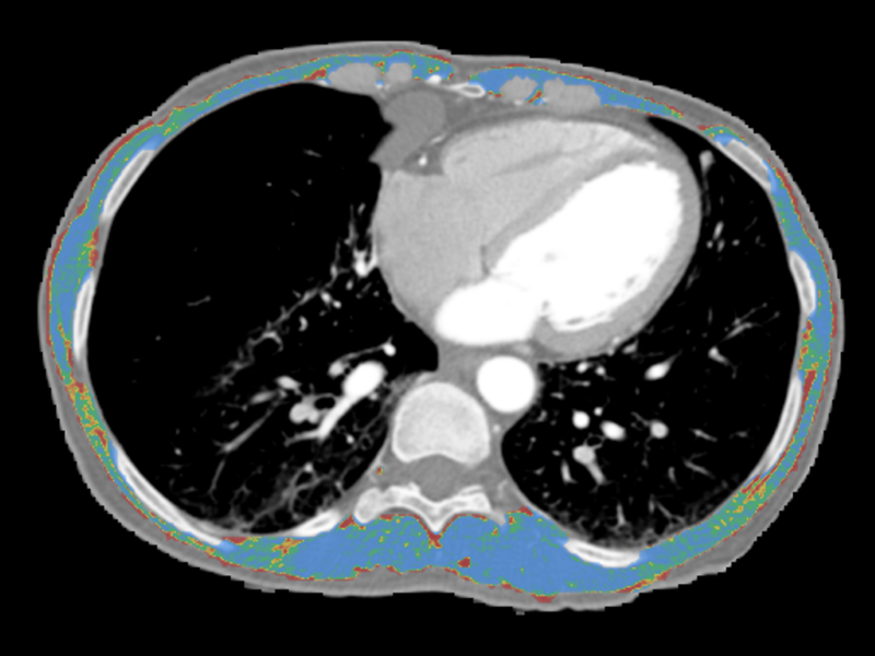 Scan image of a chest with high-density muscle