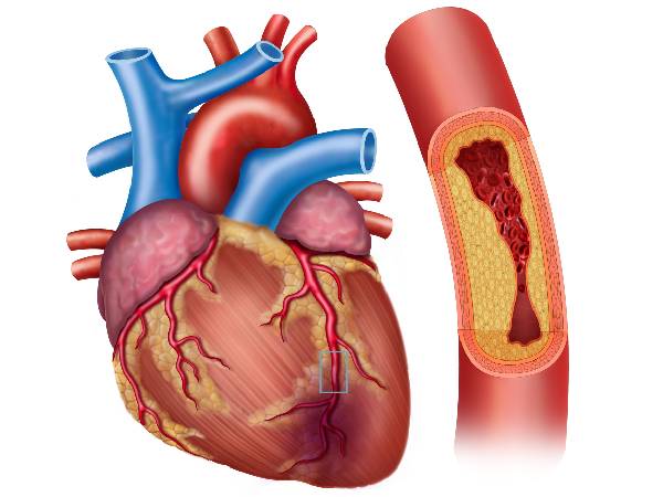 an illustration of a heart affected by coronary heart disease