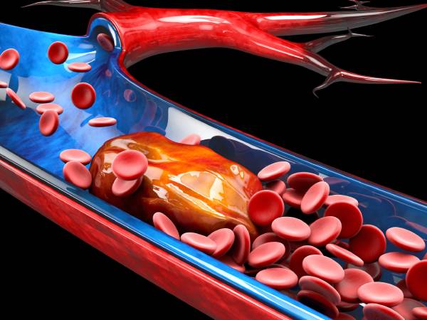 a 3d illustration of healthy red blood cells in a blood vessel being blocked by a blood clot